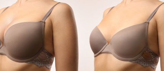 lipofilling mammaire
