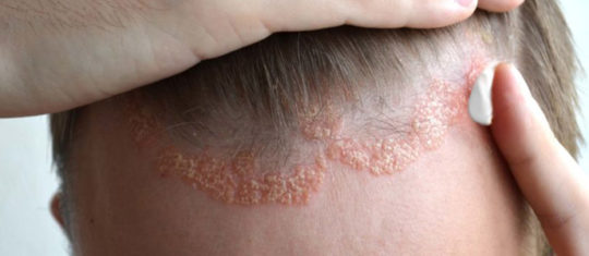 eczéma du cuir chevelu